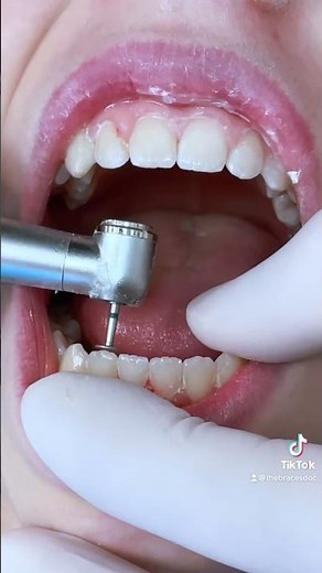 Enameloplasty - Filing Edges of Your Teeth w/ TheBracesDoc