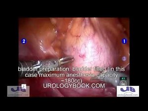 Robotic Bladder Augmentation with Intracorporeal Bowel Anastomosis in Adult Female • Video • MEDtube.net