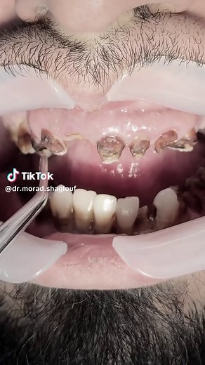 Transforming Damaged Teeth with Zirconia Crowns