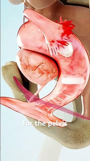 Vaginal Pessary Insertion Explained (3D Animation)#vaginalpessary #womenshealth #gynecology