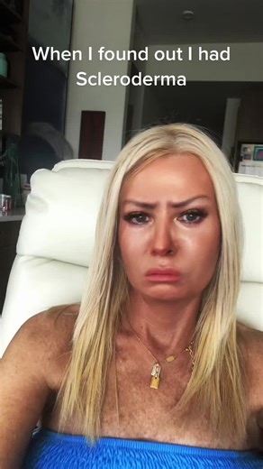 Understanding Scleroderma: My Journey with the Autoimmune Disease