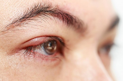 Here's What To Do (And Not To) if You Have a Stye