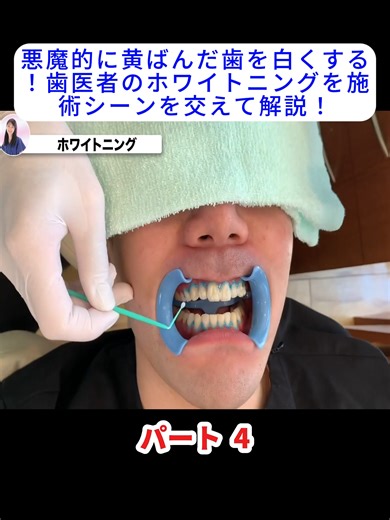 悪魔的に黄ばんだ歯を白くする！歯医者のホワイトニングを施術シーンを交えて解説！#歯医者 #口元美容 #詰め物 #for #yourpage #japan