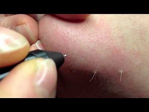 Epilation definitive poils blancs