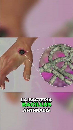 Todo sobre el Carbunco La Amenaza del Ántrax #EnfermedadesMortales #EdadMedia #Epidemias