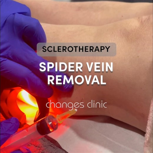 Restore confidence in your legs! Minimal downtime. €350. Includes compression tights. | Changes Clinic