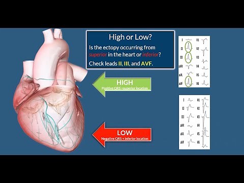 RVOT PVCs Localization