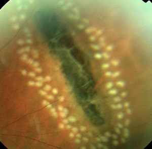Peripheral retinal degeneration - Diagnosis - Video
