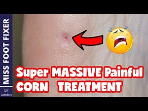 Super Massive Painful Deep Corn Removal **** Deep Corn *** Full Treatment By Miss Foot Fixer