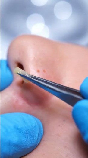 Satisfying Deep Pore Cleaning with Blackhead Vacuum Tool