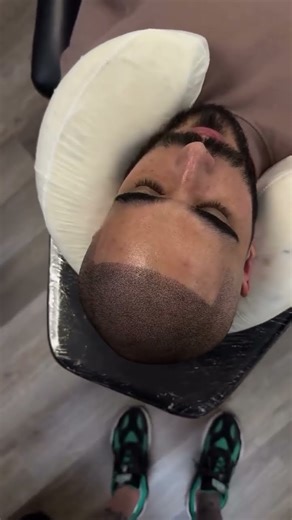 Full Journey: Scalp Micropigmentation Transformation 👤✨