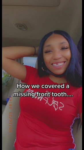 Covering a Missing Front Tooth for a Client in the USA