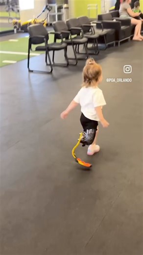 23K views · 566 reactions | Last week, Nikolina wasn’t too excited about testing her running blade, but when she saw her finished, glittery prosthesis yesterday, that was a game changer! She will be running faster and farther in no time! ✨ #poaorlando #prosthetics #amputee #running #runningblade #fast #timetofly #poakids #beachtime #liveyourbestlife #style #glitter #fun #tuesday | Prosthetic & Orthotic Associates (POA) | Facebook