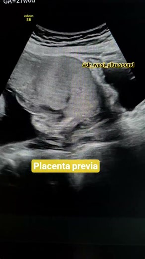 placenta Previa #dr_wasi_ultrasound