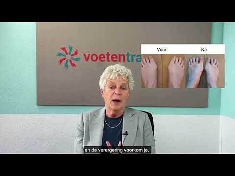 Gratis oefeningen van Voetentraining. Voorkom dat je hallux valgus erger wordt.