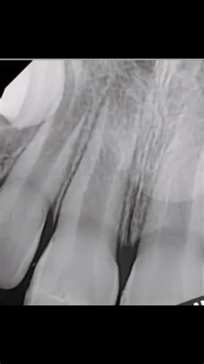 Dr Rico Short on Instagram: "Open Apex Case With Trauma On A 7 Year Old. Do you perform Apexogenesis, Regeneration, or Apexification? What Types Of Irrigation Is Best? What Bioceramic Material Works Best? It’s All In Endodontic Keys And Cases! Available On Amazon. #drricoshort #endodontickeysandcases #dentistry #Apexogenesis #Bioceramics #MTA"