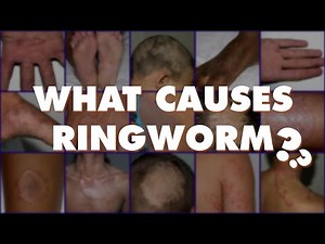 Ringworm- Dr Explains- Signs Symptoms Pictures