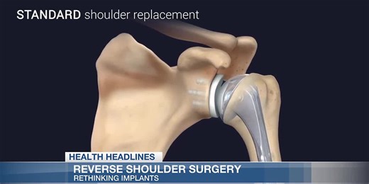 Health Headlines: Rethinking implants with reverse shoulder surgery