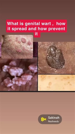 Nurse Beryl on Instagram: "Genital warts are small growths or bumps that appear on or around the genital and anal area. They are a sexually transmitted infection (STI) caused by certain types of the human papillomavirus (HPV)—most commonly HPV types 6 and 11. These warts can be flat or raised, soft or rough, and may appear singly or in clusters that sometimes look like a cauliflower. Some people feel itching, discomfort, or mild pain, while others may have no symptoms at all. ✍🏾How genital wart