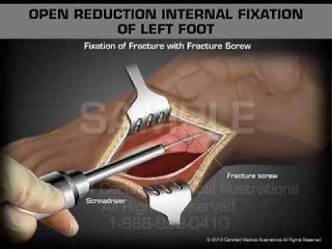 Open Reduction Internal Fixation of Left Foot