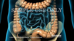 7.1K views · 185 reactions | Laparoscopic Appendectomy is a minimally invasive surgical technique done to remove an inflamed appendix. This procedure is preferred by many patients because it has good cosmetic effect and less duration of hospital stay. Courtesy: Nucleus Medicine | Medrockets | Facebook