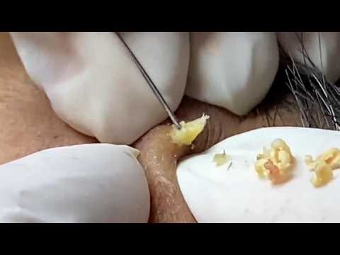 Extreme Acne Extraction | Giant Pimple Popping Compilation