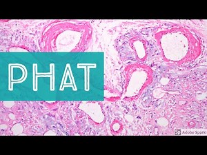 PHAT: Pleomorphic Hyalinizing Angiectatic Tumor 101