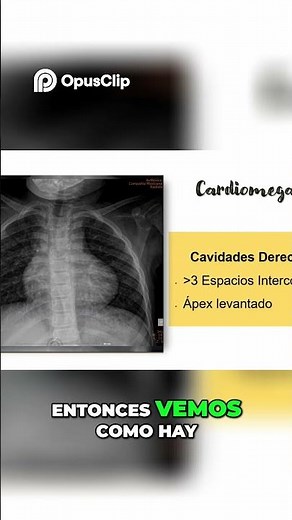 Tetralogy of Fallot - Diagnosis and Key Features #cardiohack