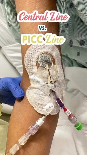 Kristine Tuttle on Instagram: "Central lines, PICC lines, and Midlines…oh my! 🩸Do you know the differences? –Central Venous Catheters (CVCs) – Placed in large vessel of neck or chest Long-term therapy for those with poor peripheral access or frequent/constant administration of fluids & medications Leads to large vessels near heart May remain in up to 6 weeks (shorter or longer depending on case) Increased risk of infection – Peripherally Inserted Central Catheter (PICC Line) – Placed peripheral