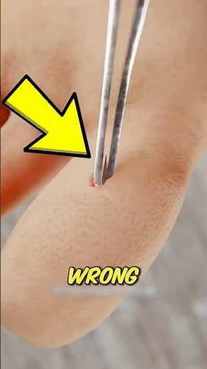 If you ever get a splinter, don't remove it like this at home