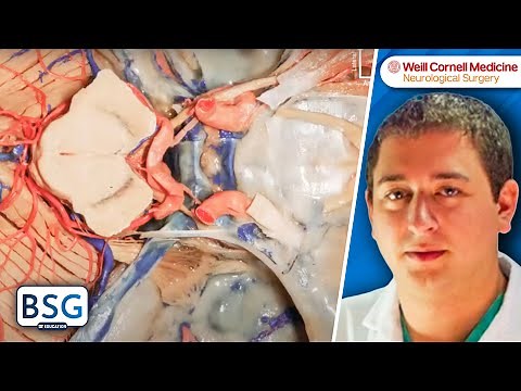 Anatomy of the Cerebellopontine Angle (CPA) Viewed from Above