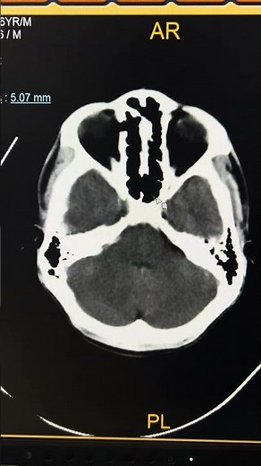 Subdural Hematoma Explained: NCCT Head Insights