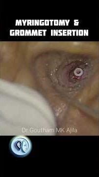 Myringotomy & Grommet insertion #otolaryngology #doctorlife #earcare #endoscopy #entdoctor #glueear