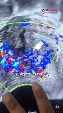 How To Identify Adenomyoma On Ultrasound? | Mamata Fertility Hospital: Hyderabad