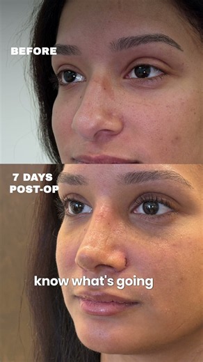 Mastering Rhinoplasty | Advanced Nose Job Techniques | Facial Plastic Surgery Before & After