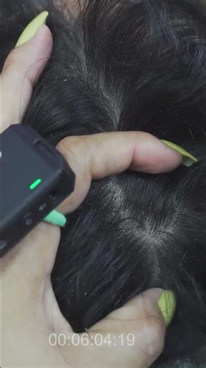 Scratching Dandruff Big Flakes On Back Side Of My Nephew