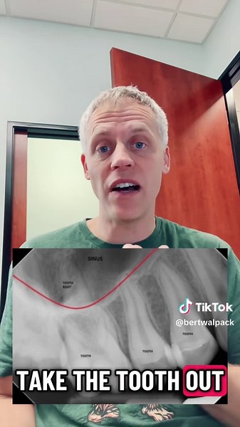 Sometimes extracting upper posterior molars you’ll get a sinus exposure. Here is how to know for sure if the hole is so small and you can’t tell. Look for the bubbles during a Val Salva maneuver. #dentist #dentalassistan #dentalhygienist #dentalstudent #oralsurgery #tooth