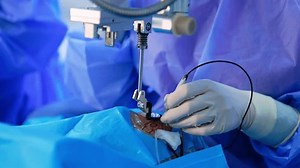 clip-3422561673-gloved-hand-holds-electric-tool-eye-patient