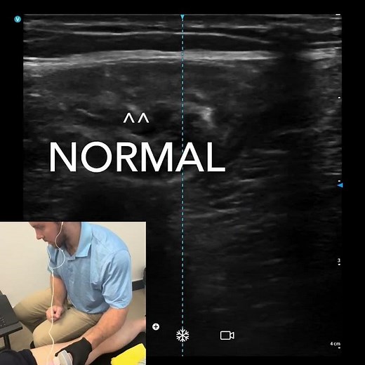 Torn Hamstring Dry Needling #ultrasound #dryneedling