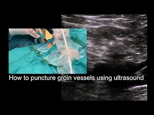 How to puncture groin vessels using ultrasound