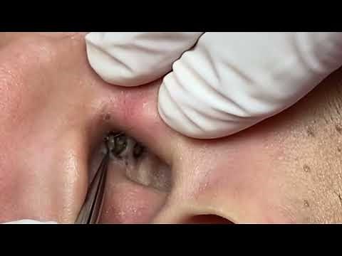 Extreme blackhead extraction! A huge one!