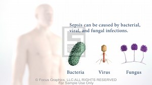 Sepsis Medical Condition