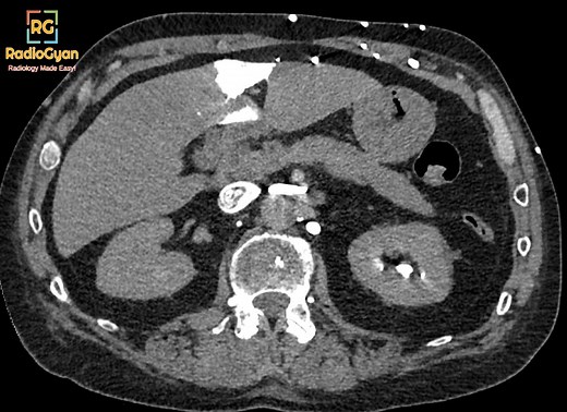 Hot Quadrate Lobe Sign - | Radiology Cases |