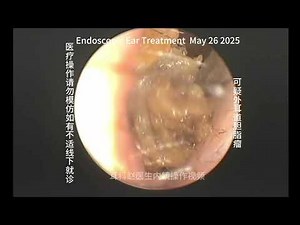 Suspected cholesteatoma of the external auditory canal 20250526