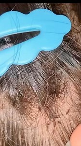 39K views · 766 reactions | Scratching my head seeing this many lice. #Lice #hanoi #pulgas #vietnam #thailand | Yulisa Rifani | Facebook