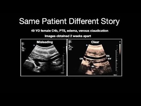 Duplex Ultrasound Optimization From Presets to Diagnostic Confidence