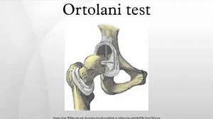 Ortolani test