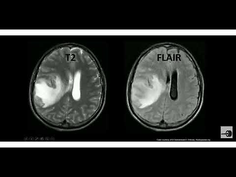 MRI Sequences (T1,T2,Flair,SWI,DWI,ADC) made easy