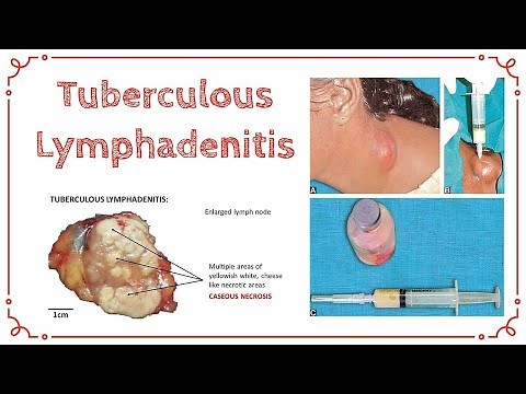 TUBERCULOUS LYMPHADENITIS | Stages Of TB Lymphadenitis | Cold Abscess | General Surgery