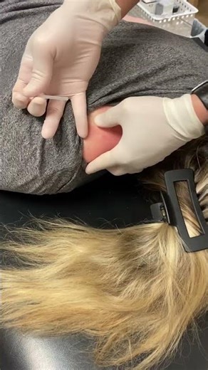 Dry needling for muscle tightness #physicaltherapy #dryneedling